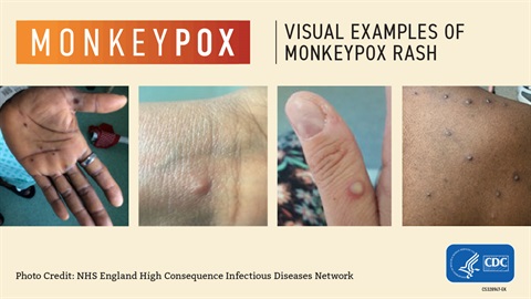 Visual examples of monkeypox rash